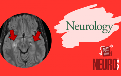 Mystery Case: Anti-NMDAR encephalitis with overlapping demyelinating syndrome