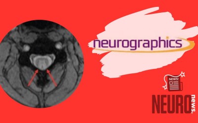 Nitrous Oxide Abuse‐Induced Subacute Combined Degeneration: Classic Neuroimaging Findings on MRI