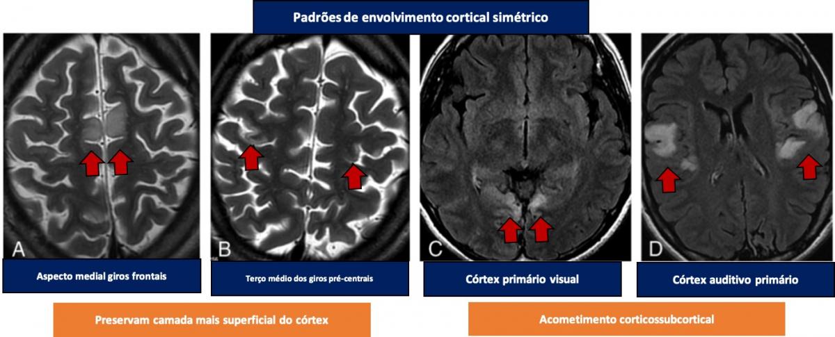 Lesões corticais agudas na síndrome MELAS: Distribuição anatômica, simetria e evolução